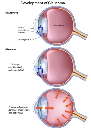 the development of glaucoma